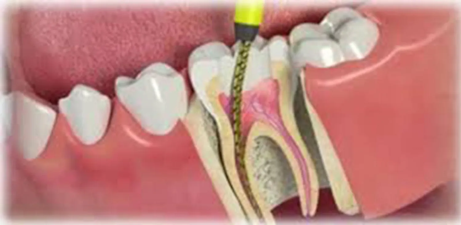  علاج الجذور